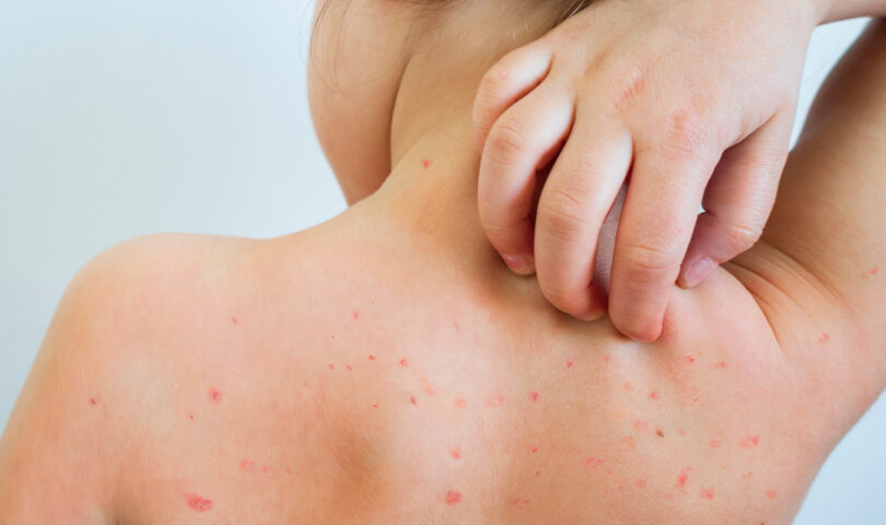 child with measles